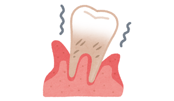 歯周病と骨粗鬆症の関係